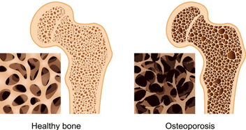 osteoporosis bones